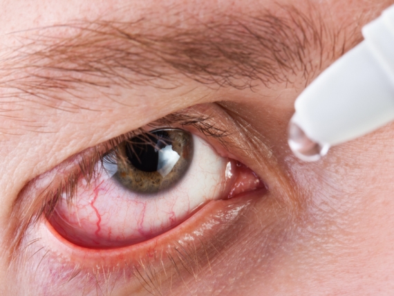 Dry Eye Symptoms  