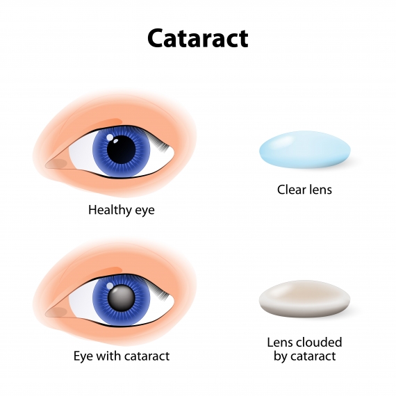 What Causes Cataracts