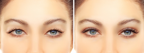 Upper Eyelid Surgery Fort Myers