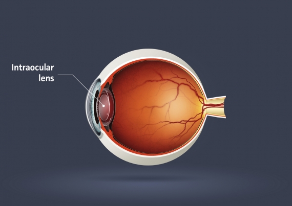 What is an Intraocular Lens for Cataract Surgery?