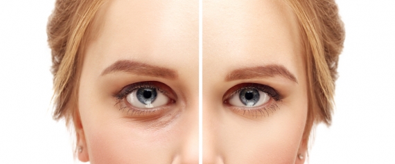 When to Have Upper Eyelid Surgery