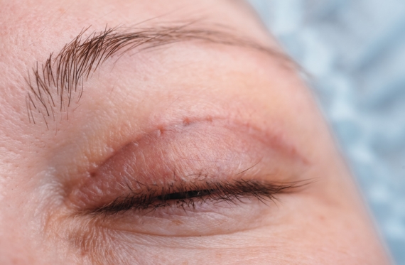 Droopy Eyelid Causes