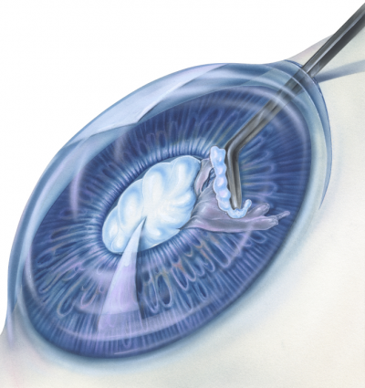 What Do Cataracts Look Like?